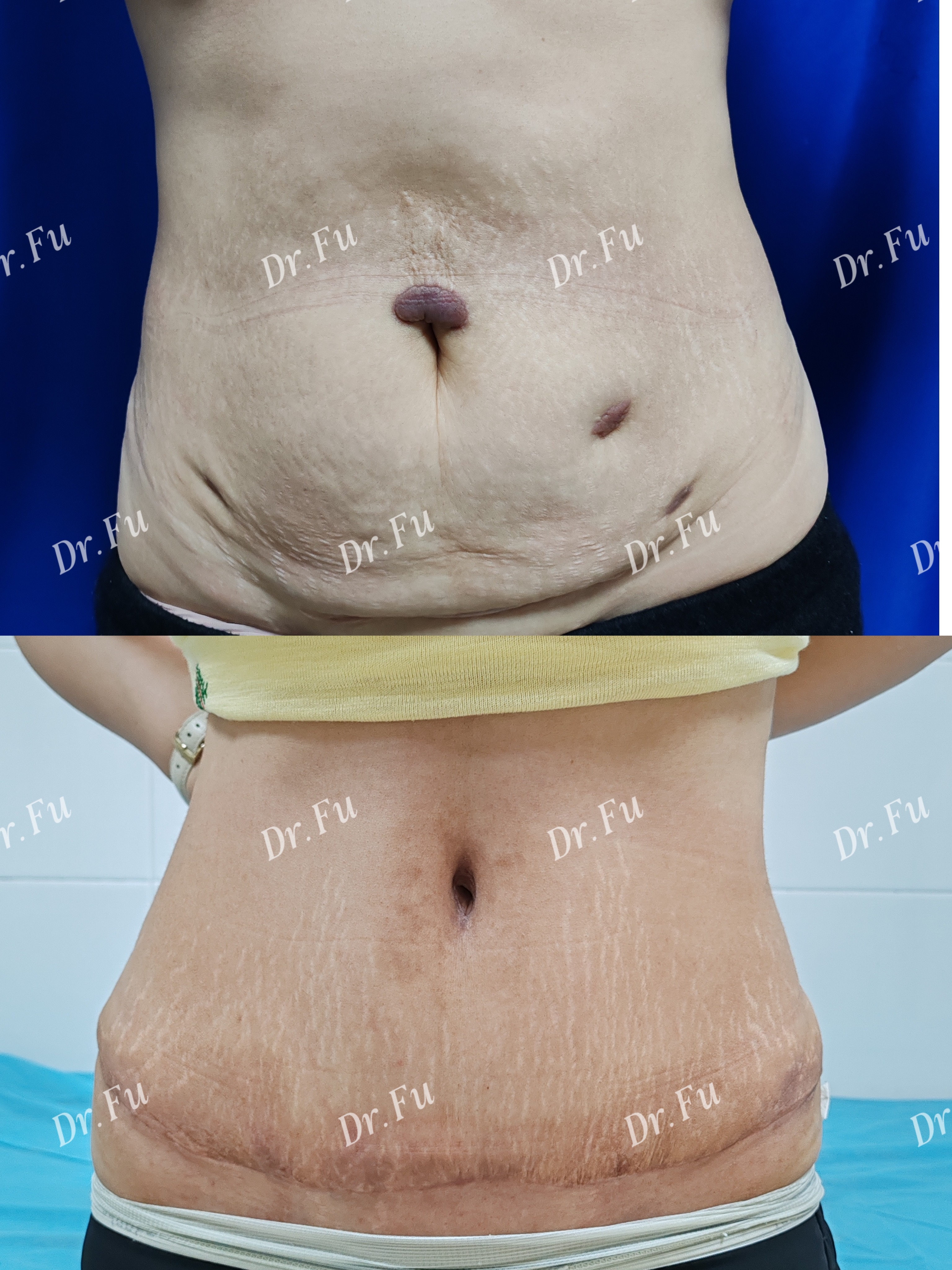 Abdominoplasty Case 5